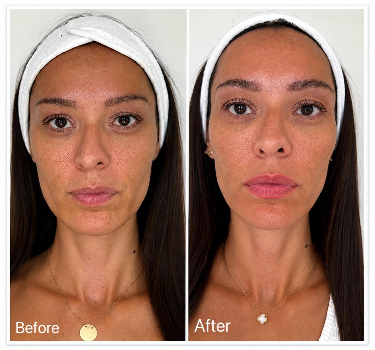 Pre i posle, Nithya collagen tretman lica