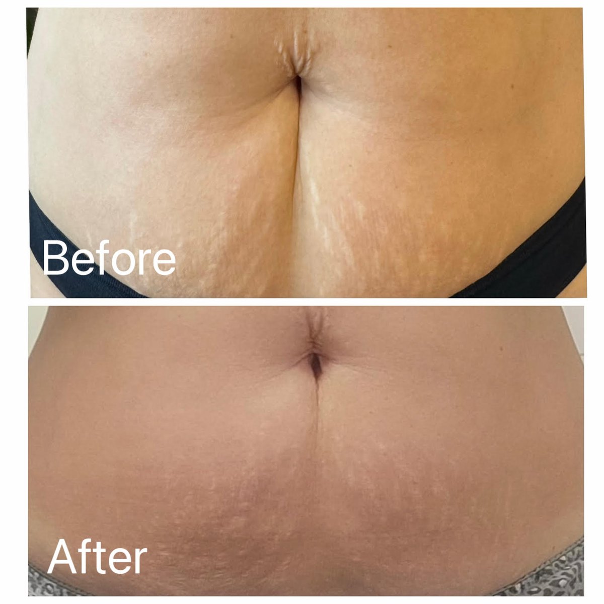Pre i posle, Nithya body tretman